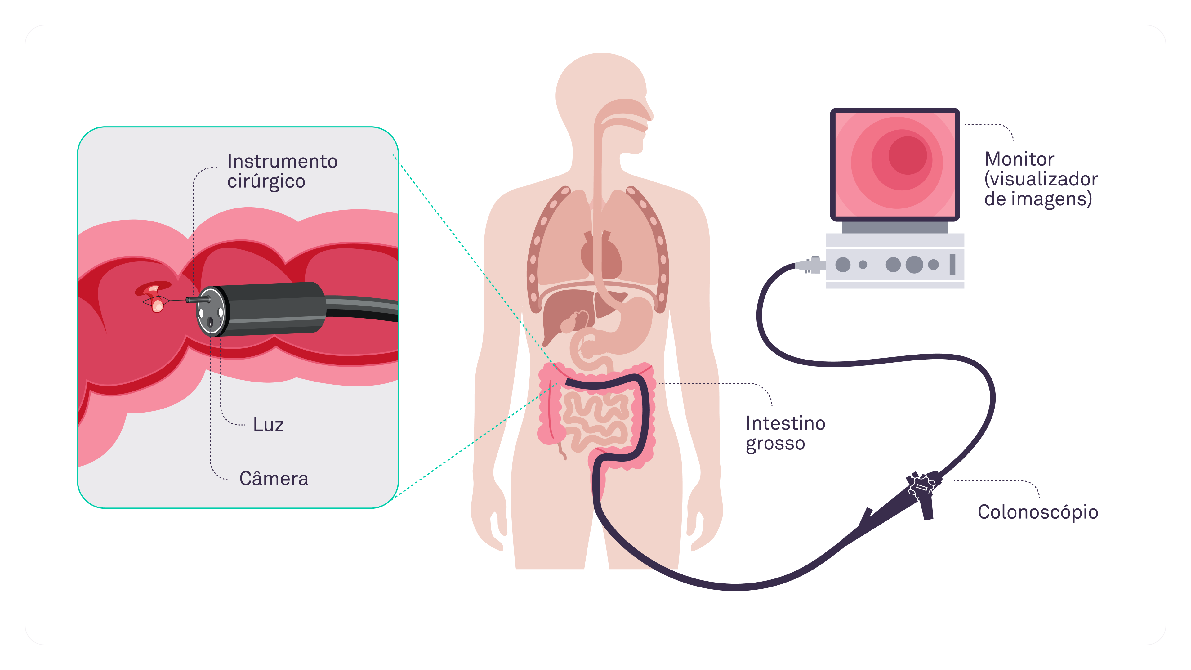 asp_colonoscope_pt